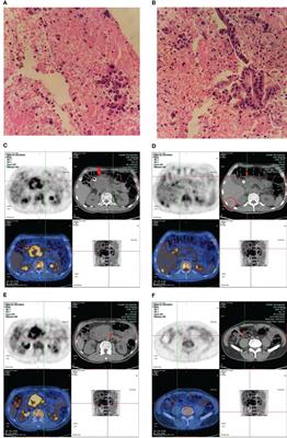 Successful Immunotherapy for Pancreatic Cancer in a Patient With TSC2 and SMAD4 Mutations: A Case Report